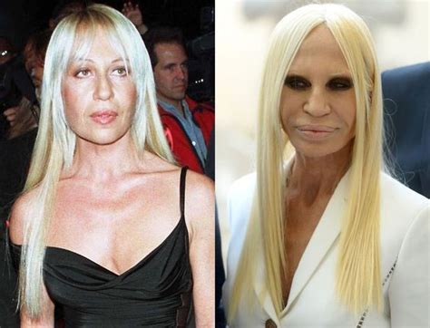 versace chirurgia plastica|donatella versace cosmetics.